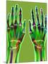 Arthritic Hands, X-ray-Du Cane Medical-Mounted Photographic Print
