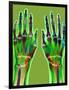 Arthritic Hands, X-ray-Du Cane Medical-Framed Photographic Print