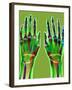 Arthritic Hands, X-ray-Du Cane Medical-Framed Photographic Print