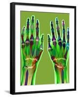 Arthritic Hands, X-ray-Du Cane Medical-Framed Photographic Print