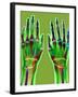 Arthritic Hands, X-ray-Du Cane Medical-Framed Photographic Print