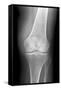 Arthritic Knee, X-ray-Du Cane Medical-Framed Stretched Canvas
