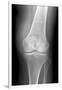 Arthritic Knee, X-ray-Du Cane Medical-Framed Photographic Print