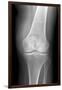 Arthritic Knee, X-ray-Du Cane Medical-Framed Photographic Print