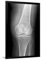 Arthritic Knee, X-ray-Du Cane Medical-Framed Photographic Print