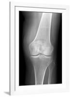 Arthritic Knee, X-ray-Du Cane Medical-Framed Photographic Print