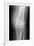 Arthritic Knee, X-ray-Du Cane Medical-Framed Photographic Print