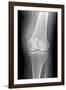 Arthritic Knee, X-ray-Du Cane Medical-Framed Photographic Print