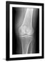 Arthritic Knee, X-ray-Du Cane Medical-Framed Photographic Print