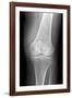 Arthritic Knee, X-ray-Du Cane Medical-Framed Photographic Print