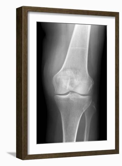 Arthritic Knee, X-ray-Du Cane Medical-Framed Photographic Print