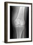 Arthritic Knee, X-ray-Du Cane Medical-Framed Photographic Print