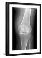 Arthritic Knee, X-ray-Du Cane Medical-Framed Photographic Print