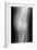 Arthritic Knee, X-ray-Du Cane Medical-Framed Photographic Print