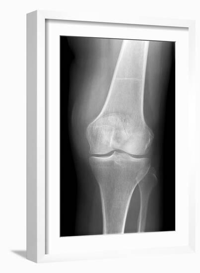 Arthritic Knee, X-ray-Du Cane Medical-Framed Photographic Print