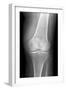 Arthritic Knee, X-ray-Du Cane Medical-Framed Photographic Print