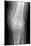 Arthritic Knee, X-ray-Du Cane Medical-Mounted Photographic Print
