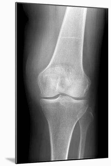 Arthritic Knee, X-ray-Du Cane Medical-Mounted Photographic Print