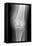 Arthritic Knee, X-ray-Du Cane Medical-Framed Stretched Canvas