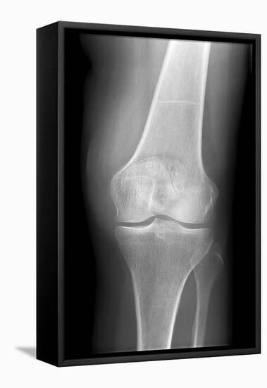 Arthritic Knee, X-ray-Du Cane Medical-Framed Stretched Canvas