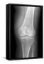 Arthritic Knee, X-ray-Du Cane Medical-Framed Stretched Canvas