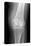 Arthritic Knee, X-ray-Du Cane Medical-Stretched Canvas