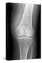 Arthritic Knee, X-ray-Du Cane Medical-Stretched Canvas