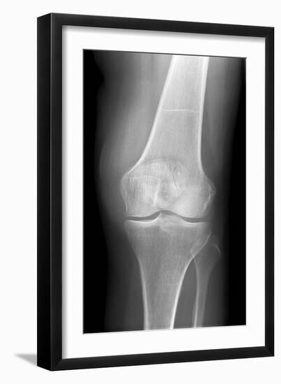 Arthritic Knee, X-ray-Du Cane Medical-Framed Premium Photographic Print