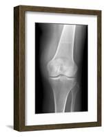 Arthritic Knee, X-ray-Du Cane Medical-Framed Photographic Print