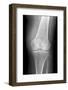 Arthritic Knee, X-ray-Du Cane Medical-Framed Photographic Print