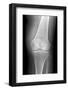 Arthritic Knee, X-ray-Du Cane Medical-Framed Photographic Print