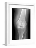 Arthritic Knee, X-ray-Du Cane Medical-Framed Photographic Print