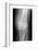 Arthritic Knee, X-ray-Du Cane Medical-Framed Photographic Print