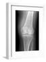 Arthritic Knee, X-ray-Du Cane Medical-Framed Photographic Print