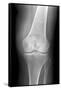 Arthritic Knee, X-ray-Du Cane Medical-Framed Stretched Canvas