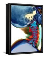 Arthritis In Neck, X-ray-Du Cane Medical-Framed Stretched Canvas