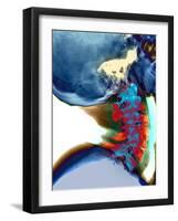 Arthritis In Neck, X-ray-Du Cane Medical-Framed Photographic Print