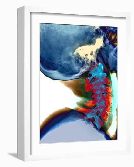 Arthritis In Neck, X-ray-Du Cane Medical-Framed Photographic Print