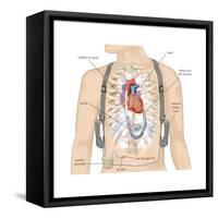 Artificial Pacemaker. Cardiovascular Disease, Cardiovascular System, Heart, Health and Disease-Encyclopaedia Britannica-Framed Stretched Canvas