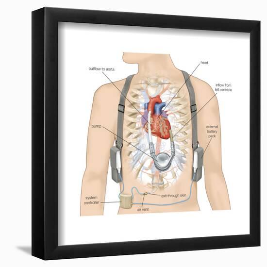 Artificial Pacemaker. Cardiovascular Disease, Cardiovascular System, Heart, Health and Disease-Encyclopaedia Britannica-Framed Poster