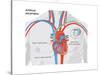 Artificial Pacemaker-Encyclopaedia Britannica-Stretched Canvas