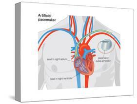 Artificial Pacemaker-Encyclopaedia Britannica-Stretched Canvas