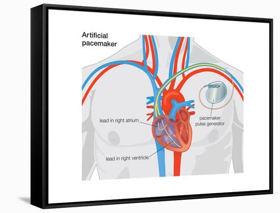 Artificial Pacemaker-Encyclopaedia Britannica-Framed Stretched Canvas