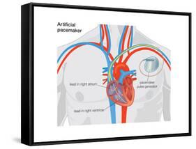 Artificial Pacemaker-Encyclopaedia Britannica-Framed Stretched Canvas