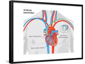 Artificial Pacemaker-Encyclopaedia Britannica-Framed Poster