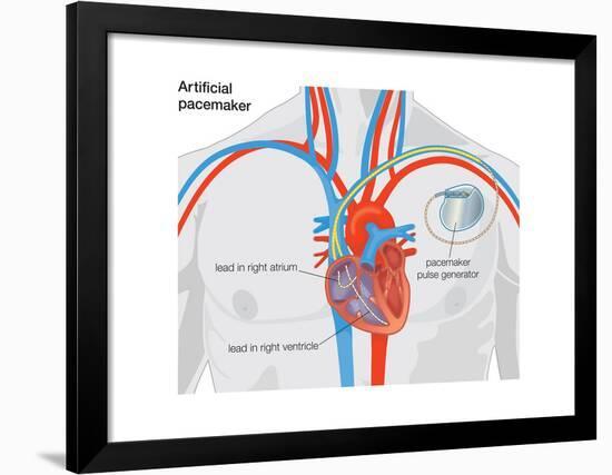 Artificial Pacemaker-Encyclopaedia Britannica-Framed Poster