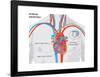 Artificial Pacemaker-Encyclopaedia Britannica-Framed Poster