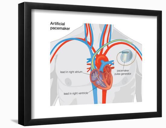 Artificial Pacemaker-Encyclopaedia Britannica-Framed Poster