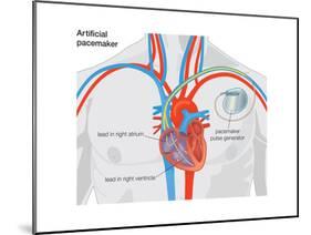 Artificial Pacemaker-Encyclopaedia Britannica-Mounted Poster