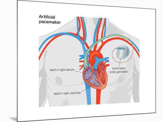 Artificial Pacemaker-Encyclopaedia Britannica-Mounted Poster